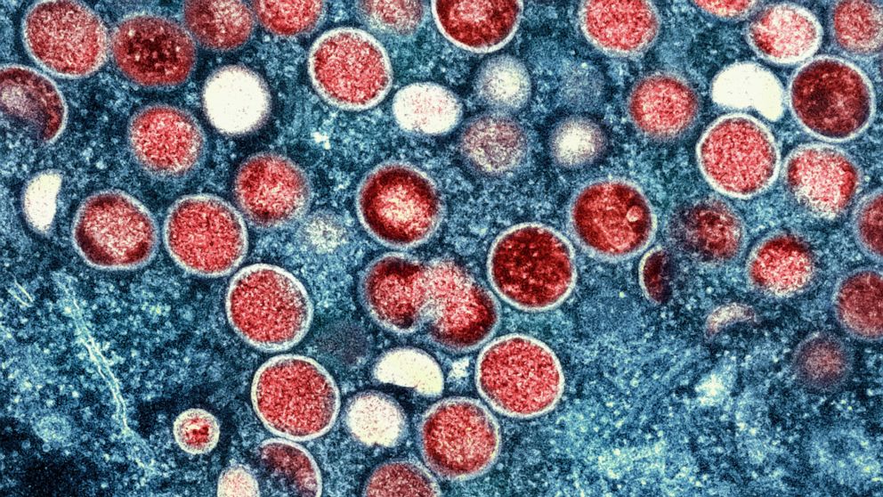 This image provided by the National Institute of Allergy and Infectious Diseases (NIAID) shows a colorized transmission electron micrograph of monkeypox particles (red) found within an infected cell (blue), cultured in the laboratory that was capture