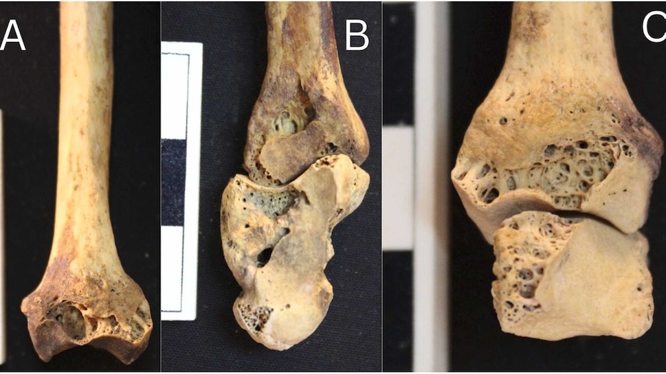 3,500-year-old burial of Nubian woman reveals 1 of world's earliest known cases of rheumatoid arthritis