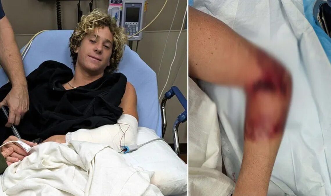 Florida teen surfer bitten by shark